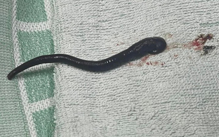 Con vắt dài gần 7cm được gắp ra từ xoang mũi bệnh nhân Con vắt dài gần 7cm được gắp ra từ xoang mũi bệnh nhân