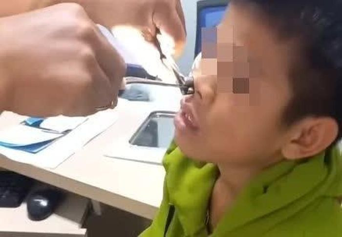 Bác sĩ gắp con vắt dài 8cm trong mũi thiếu niên