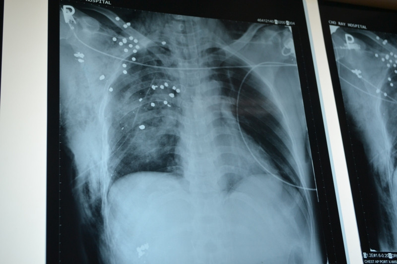 Vẫn còn hơn 20 mãnh đạn hoa cải găm vào phổi nạn nhân. Ảnh L.N