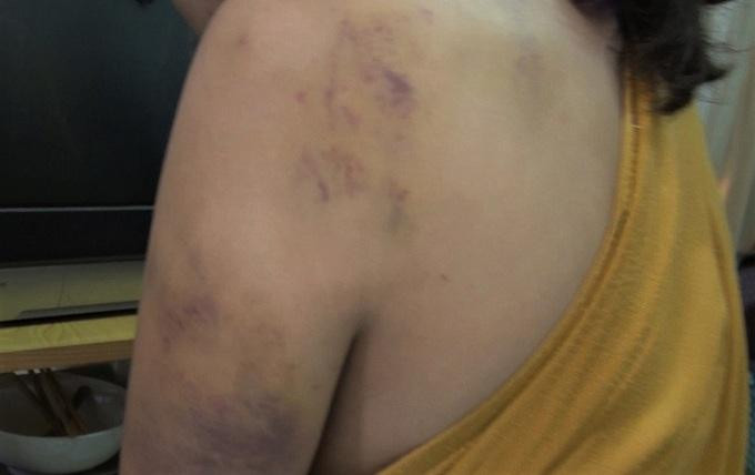 Vết bầm trên vai một thiếu nữ bị chủ quán karaoke Hoàng Gia đánh đập. Ảnh: Phạm Linh.