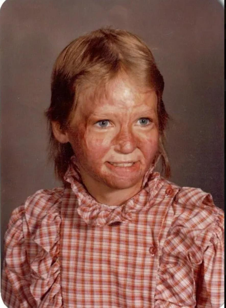 Được biết, năm 10 tuổi, Danette bị bỏng đến 70% cơ thể trong vụ hỏa hoạn nổ khí đốt đốt tầng hầm của nhà cô; thậm chí lúc đó bác sĩ còn tiên lượng xấu về tình trạng của cô và khuyên gia đình nên chuẩn bị tâm lí. May mắn rằng phép màu đã đến và Danette sống sót thần kỳ. "Tôi đã tỉnh lại và sau đó vượt qua rất nhiều đau đớn, hàng trăm cuộc phẫu thuật, vật lý trị liệu trong nhiều năm", cô kể.