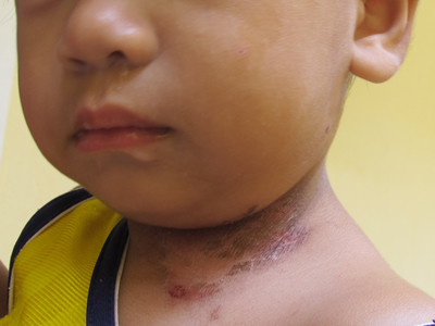 Bệnh lạ xuất hiện trên vùng cổ của một em bé tại khu chung cư Hương Sơ. Ảnh: Ngọc Văn. Bệnh lạ xuất hiện trên vùng cổ của một em bé tại khu chung cư Hương Sơ. Ảnh: Ngọc Văn