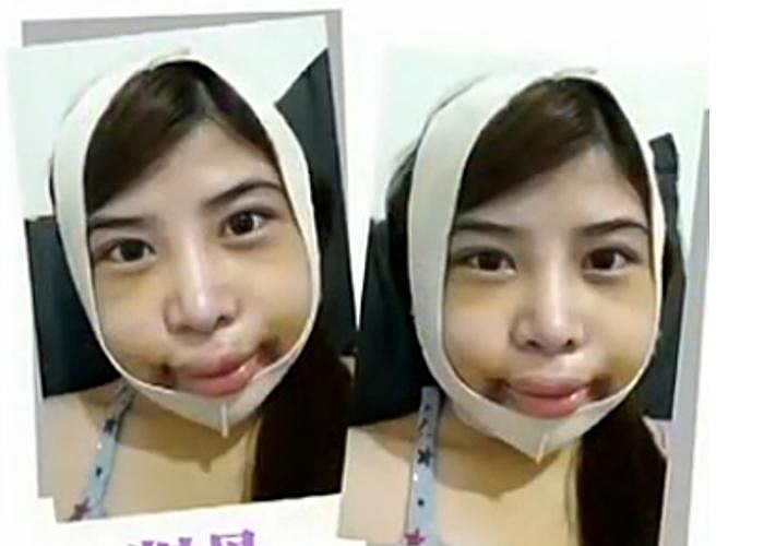 Hình ảnh Dora 1 tuần sau ca phẫu thuật