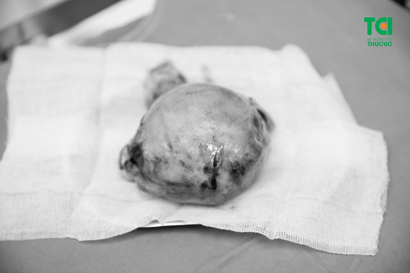 Hình ảnh khối u xơ tử cung to đã “sinh sống” cùng chị Hòa trong nhiều năm