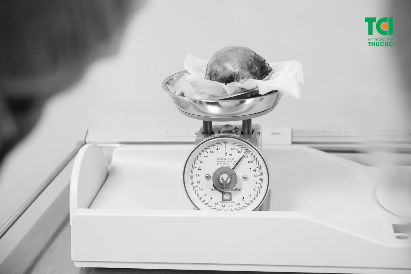 Khối u xơ tử cung của bệnh nhân có trọng lượng nửa kilogam, tương đương thai nhi 20 tuần