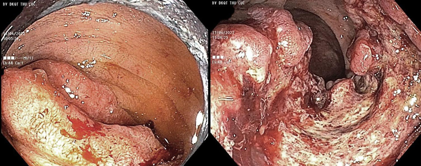 Khối sùi loét trong đại tràng của bệnh nhân N.V.N (trái) và bệnh nhân N.T.Q (phải) qua hình ảnh nội soi (ảnh đã được xử lý màu sắc)