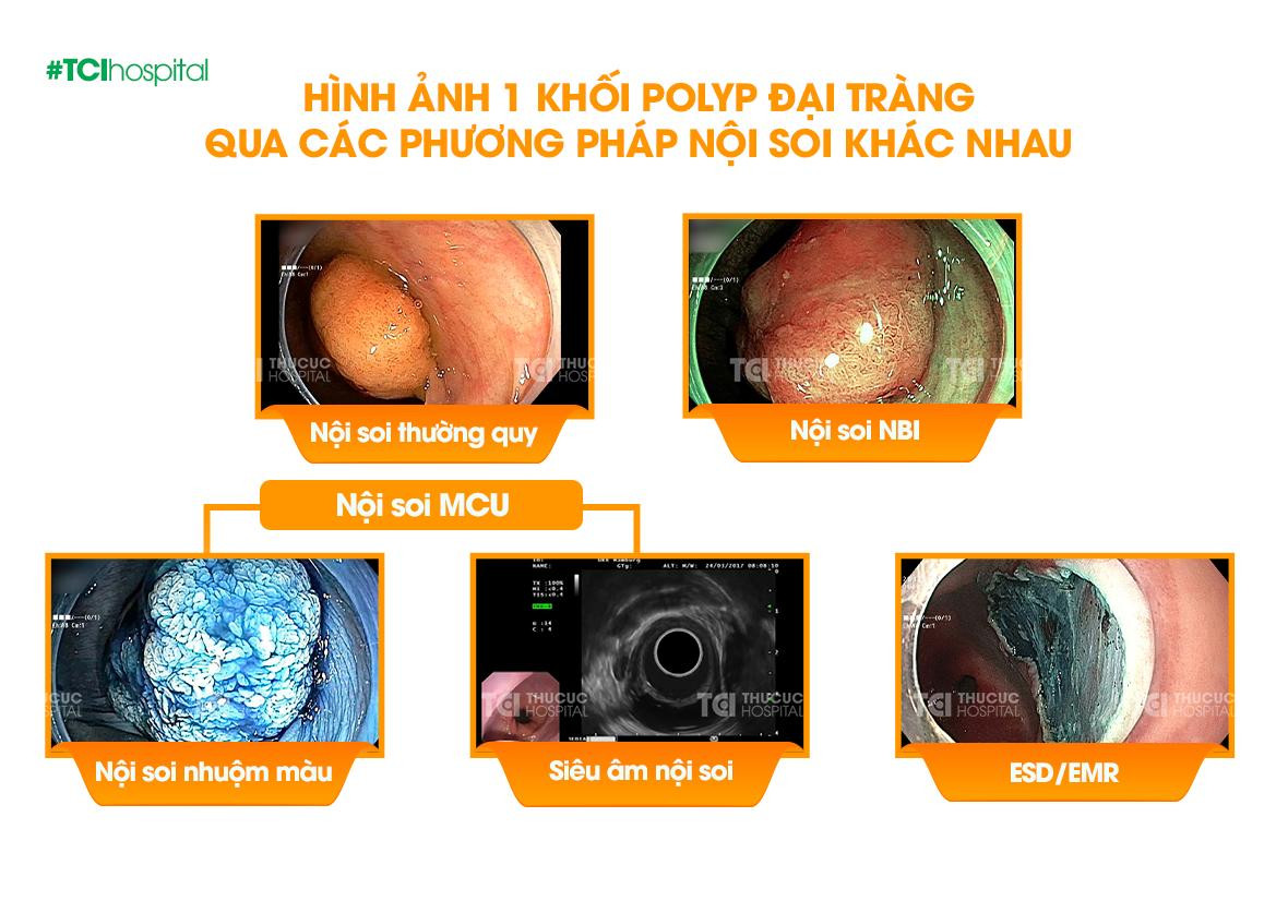 Công nghệ nội soi MCU vượt trội cả về khả năng chẩn đoán và điều trị ung thư đường tiêu hóa giai đoạn sớm