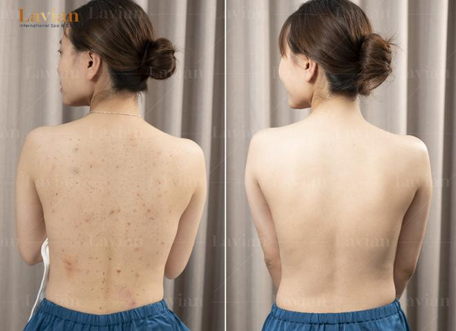 Trước và sau khi điều trị viêm da bằng hoạt chất Bioskin mang tới kết quả điều trị tích cực, sự hài lòng cho khách hàng