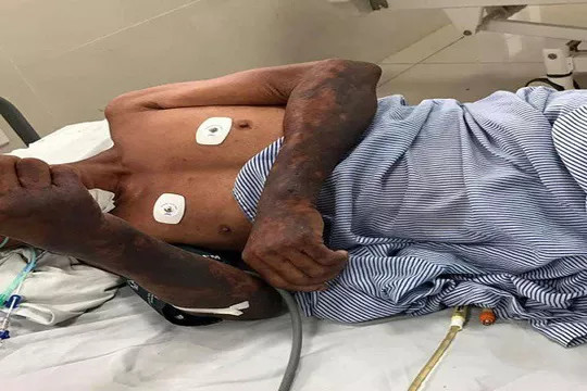 Quảng Bình: Ăn tiết canh lợn, một người đàn ông tử vong ảnh 1