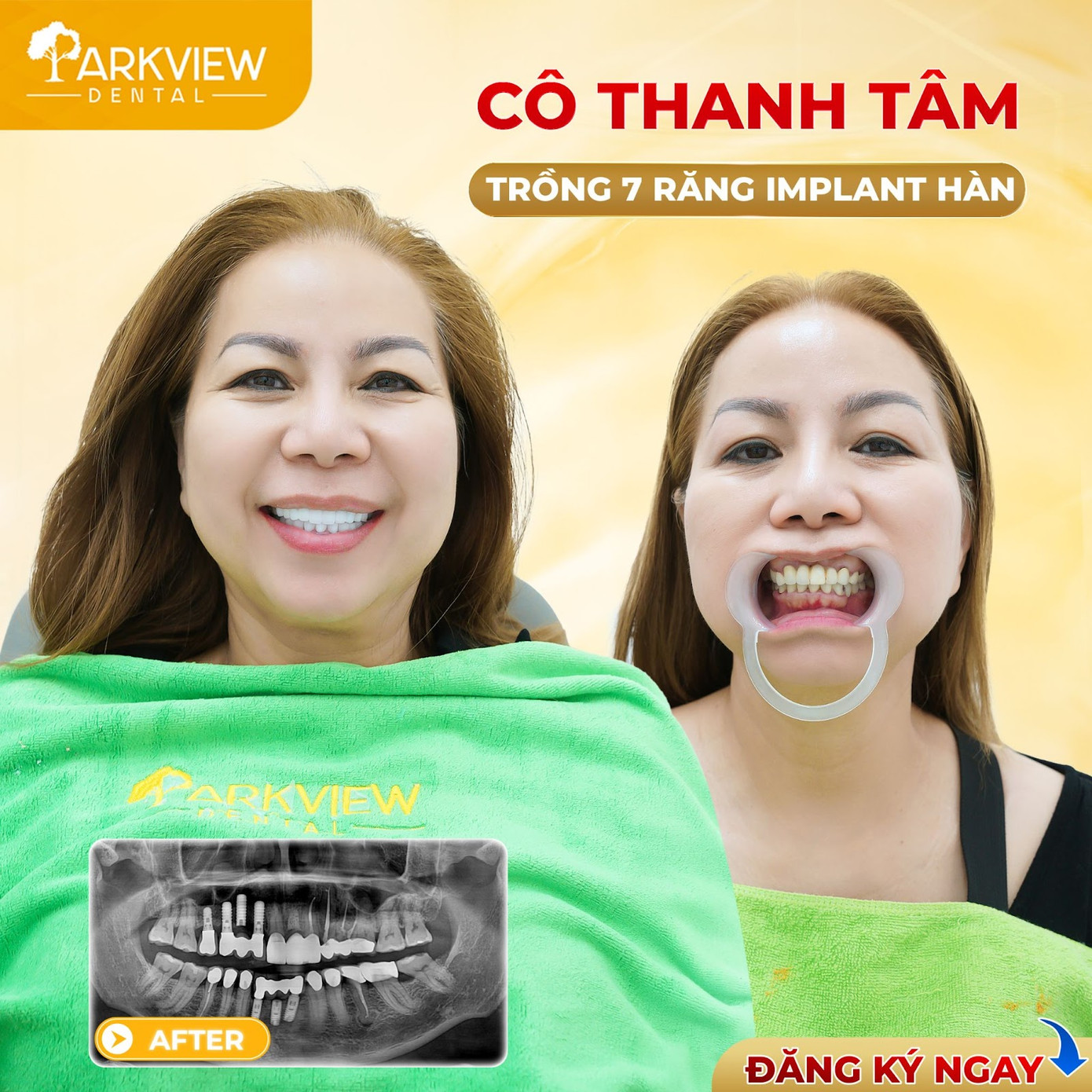 Parkview Dental - Nha khoa tiên phong trong ứng dụng các giải pháp tiên tiến trong trồng răng Implant ảnh 1