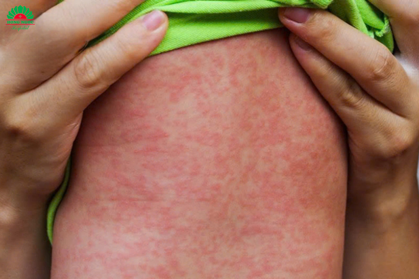 Nhiều trẻ mắc sởi nhập viện trong tình trạng biến chứng nặng Nhiều trẻ mắc sởi nhập viện trong tình trạng biến chứng nặng