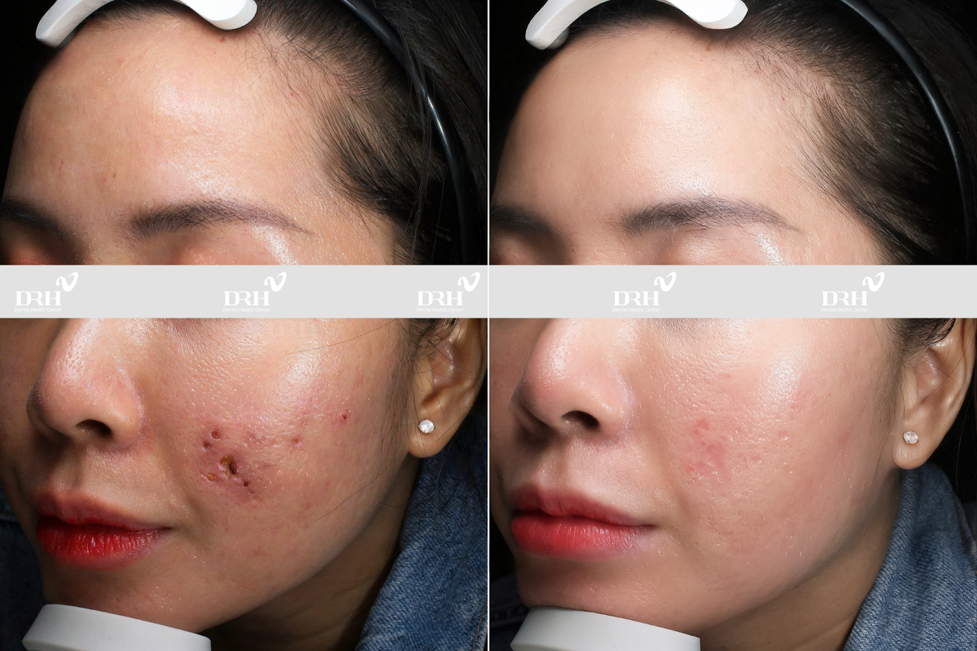 DRH Clinic đã phục hồi thành công làn da bị biến chứng do tiêm mesotherapy
