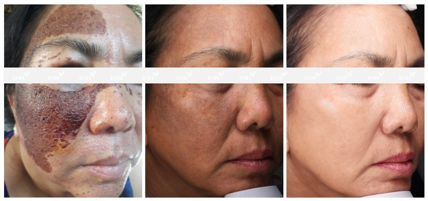 DRH Clinic giải cứu thành công khách hàng gặp phải biến chứng khi chăm da xâm lấn
