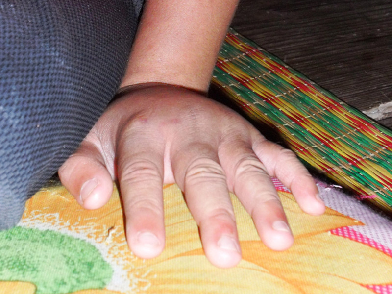 Bàn tay của bé Nhân sưng húp