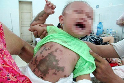 Cháu Huỳnh Tấn Bảo khóc liên tục vì các vết bỏng trên người gây đau đớn. Ảnh: Người lao động Cháu Huỳnh Tấn Bảo khóc liên tục vì các vết bỏng trên người gây đau đớn