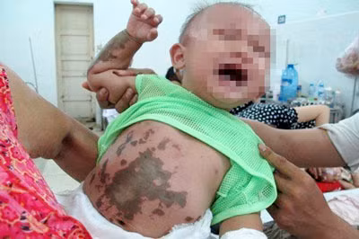 Cháu Huỳnh Tấn Bảo khóc liên tục vì các vết bỏng trên người gây đau đớn