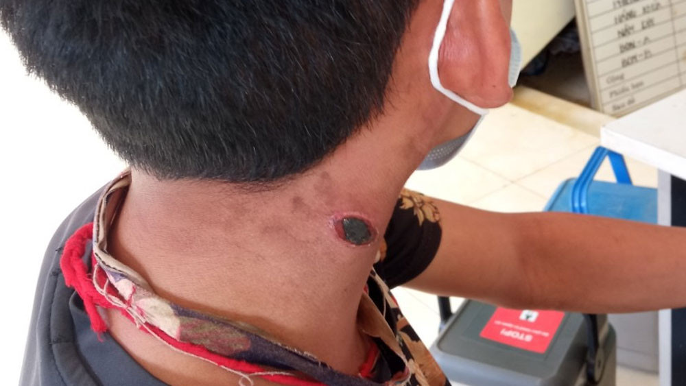 Người dân mắc bệnh than ở tỉnh Điện Biên