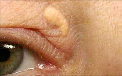 Biểu hiện của bệnh u vàng. Biểu hiện của bệnh u vàng