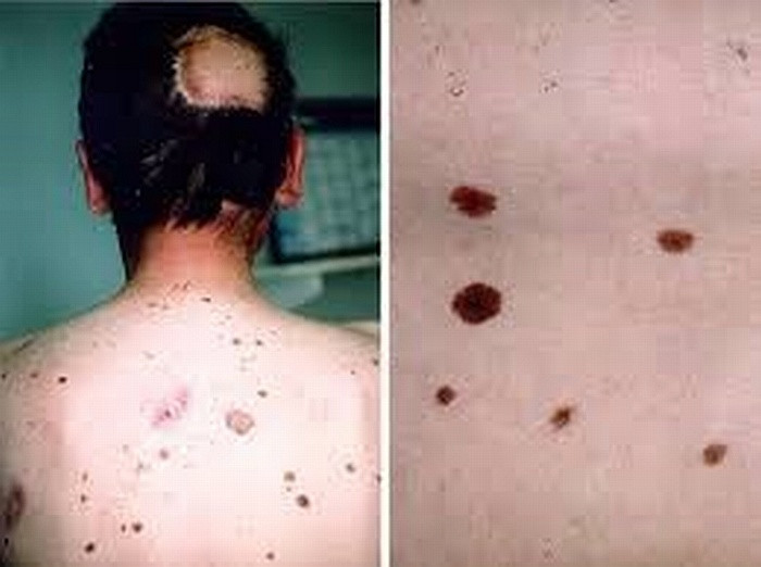  Nevus loạn sản: có xu hướng lớn hơn so với nốt ruồi bình thường, thường được pha trộn màu sắc với số lượng lớn. Một nevus loạn sản có thể làm phát sinh khối u ác tính