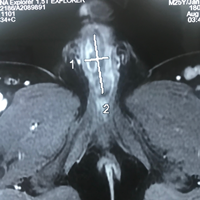 Lấy cuộn cước câu 'ở' trong niệu đạo nam thanh niên 11 năm ảnh 2