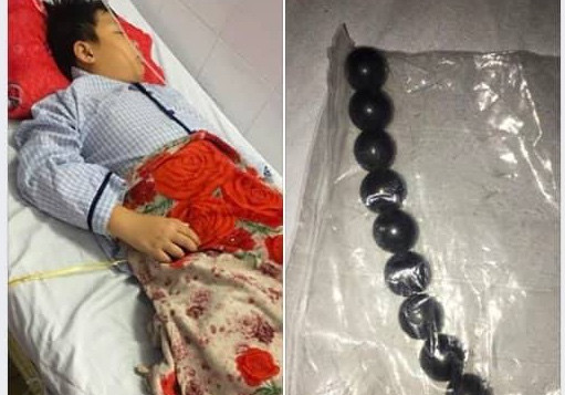 Bé trai 10 tuổi hoại tử ruột vì bị bạn ép nuốt 9 viên bi sắt? ảnh 1