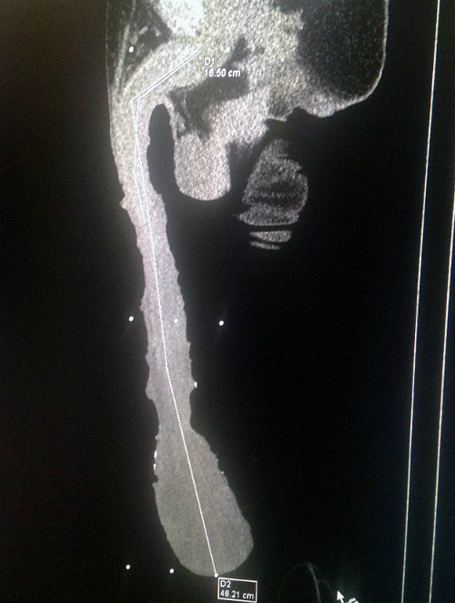 Các bác sĩ đã kiểm tra và xác định chiều dài dương vật phần lớn là bao quy đầu. Ảnh: Mens Health.