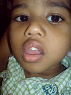  Các dấu hiệu chính khi trẻ mắc viêm VA. Ảnh: BVCC 