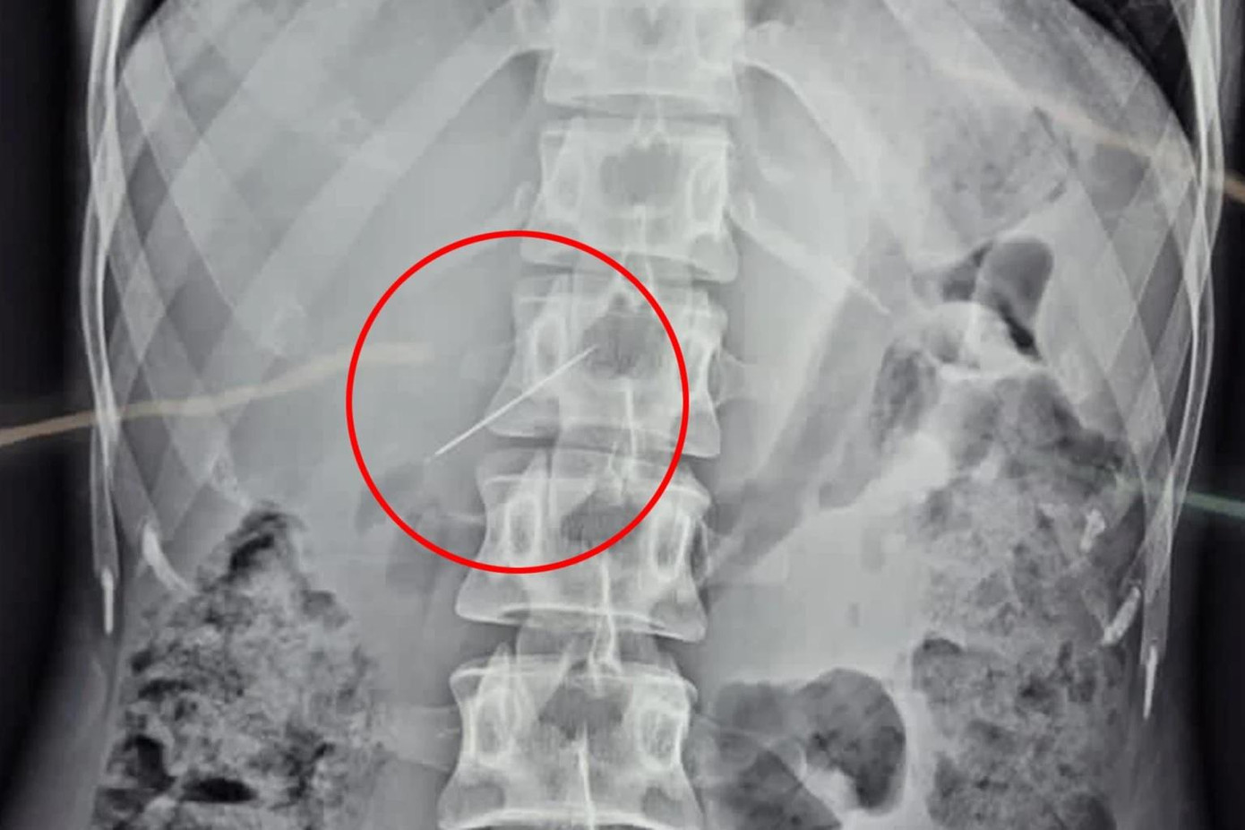 Chiếc kim khâu vô tình lọt vào cơ thể người phụ nữ và được các bác sỹ mổ nội soi lấy ra.