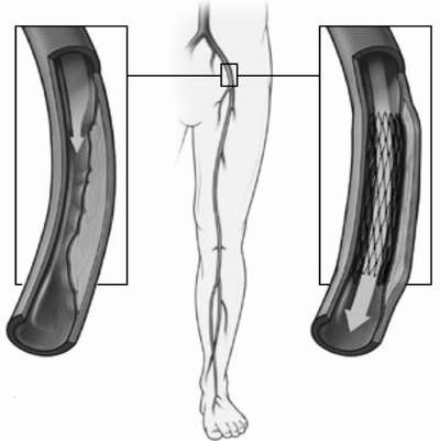 Động mạch chi bị tắc trước khi can thiệp và được thông sau khi can thiệp đặt stent