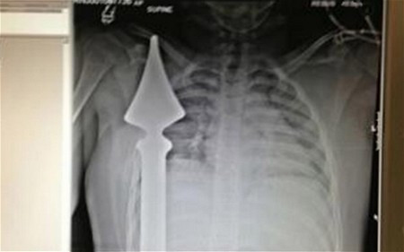 Hình chụp phim X-Quang cho thấy cọc nhọn hàng rào đâm xuyên qua người cậu bé. Hình chụp phim X-Quang cho thấy cọc nhọn hàng rào đâm xuyên qua người cậu bé