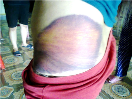 Chị Biên bị đánh bầm tím trên người. Chị Biên bị đánh bầm tím trên người