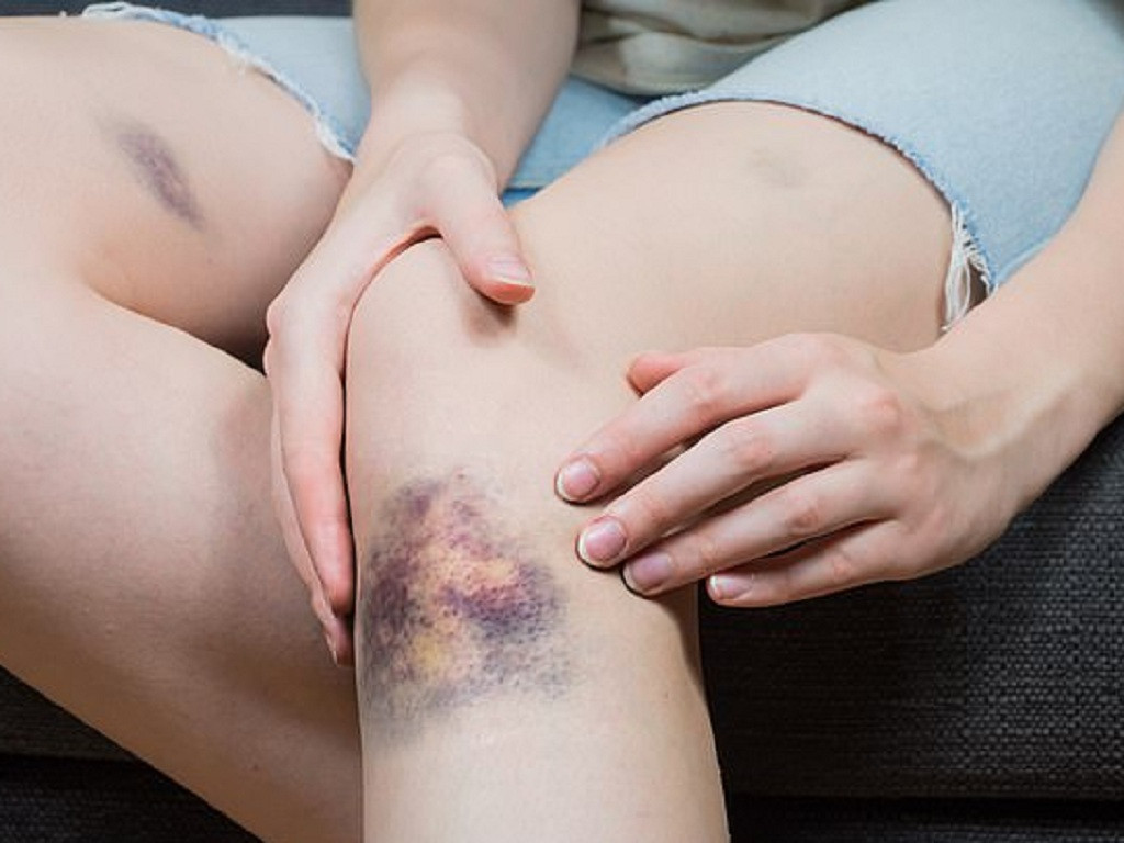 Nếu không được phát hiện và điều trị, xuất huyết giảm tiểu cầu miễn dịch có thể dẫn đến chảy máu nghiêm trọng, bao gồm chảy máu não hoặc nội tạng, có thể gây tử vong. Chảy máu nội sọ là một biến chứng hiếm gặp nhưng nghiêm trọng của bệnh. Ảnh minh họa: Internet