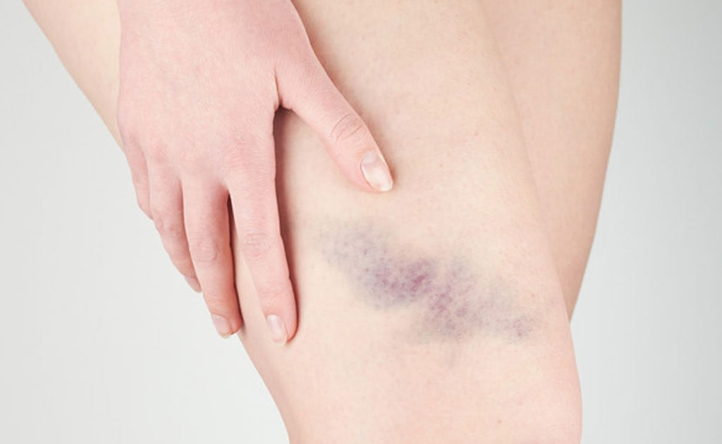 Vết bầm tím không rõ nguyên nhân là một trong những dấu hiệu của bệnh xuất huyết giảm tiểu cầu miễn dịch. Ảnh minh họa: Internet