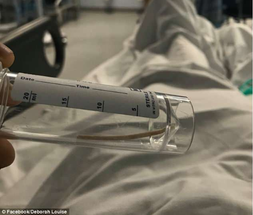 Que tránh thai 'đi lạc' tới tim, kẹt trong động mạch phổi suốt 2 năm ảnh 2