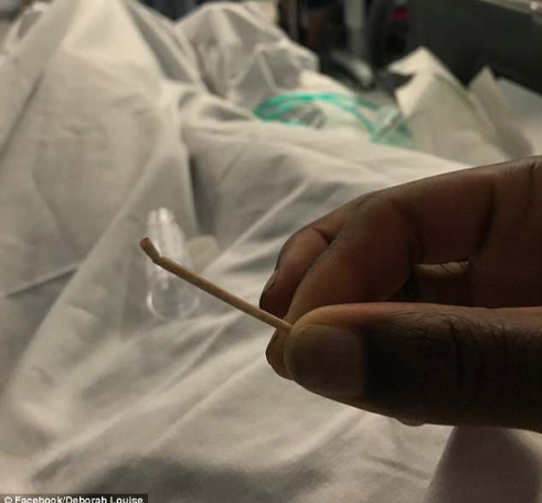 Que tránh thai 'đi lạc' tới tim, kẹt trong động mạch phổi suốt 2 năm ảnh 1