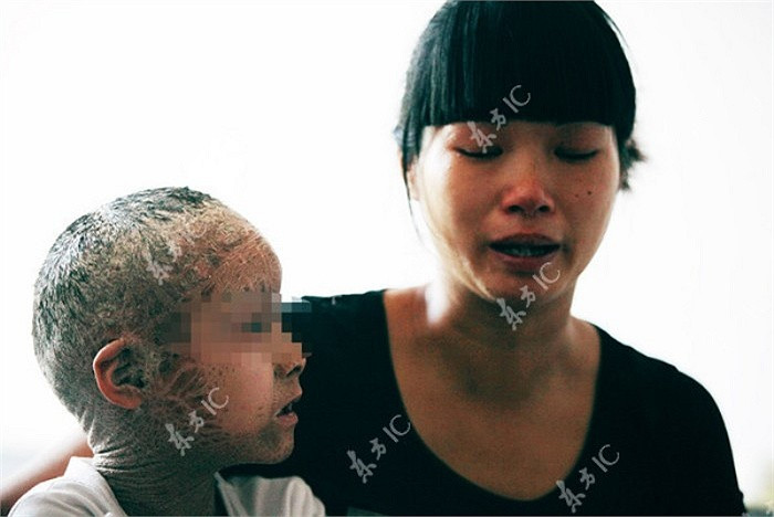 Theo mẹ của bé Pan thì con trai bà rất muốn đến trường mà không phải gãi ngứa cơ thể suốt như thế này