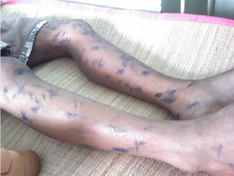 Một bệnh nhân bị thủy đậu đang được điều trị tại Bệnh viện Nhi đồng 2. Ảnh: L.N