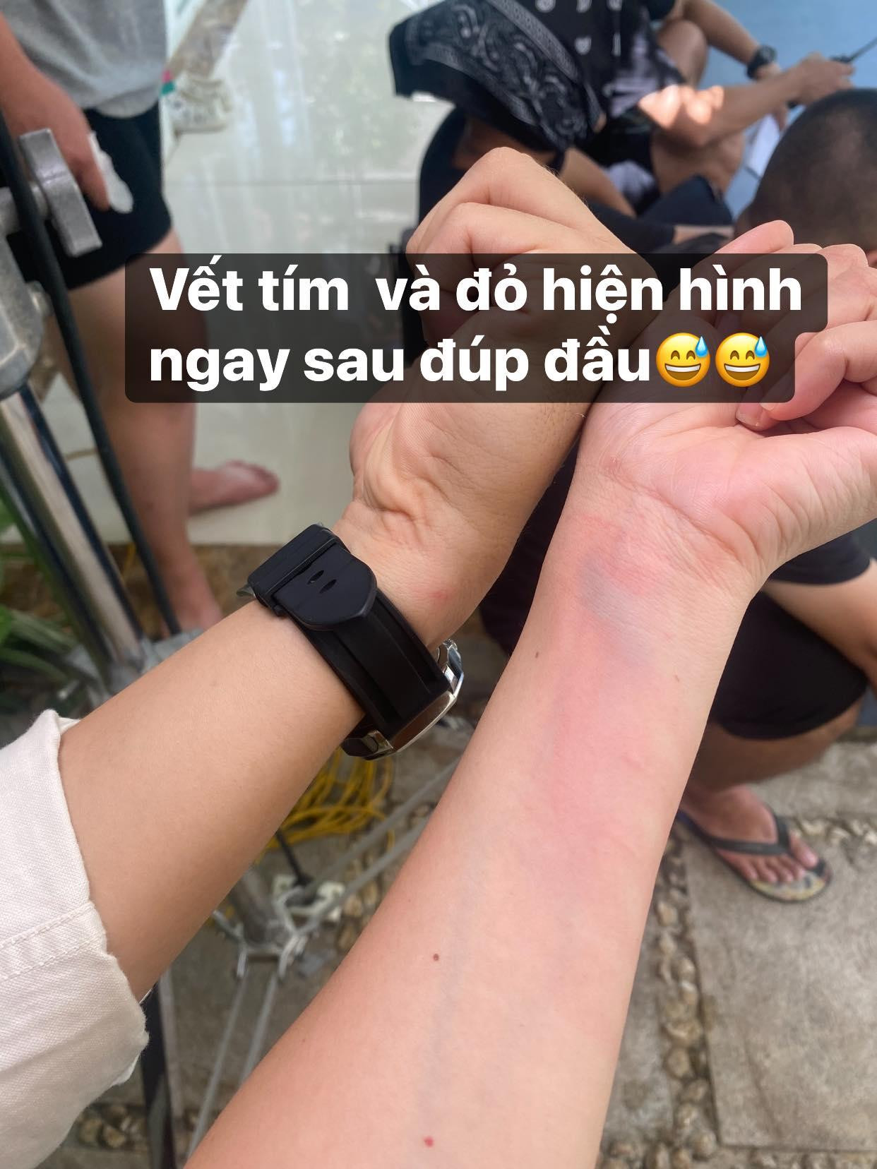 Những vết bầm tím trên tay Diễm Hương và Bình An sau cảnh quay bị Quỳnh Kool tát.