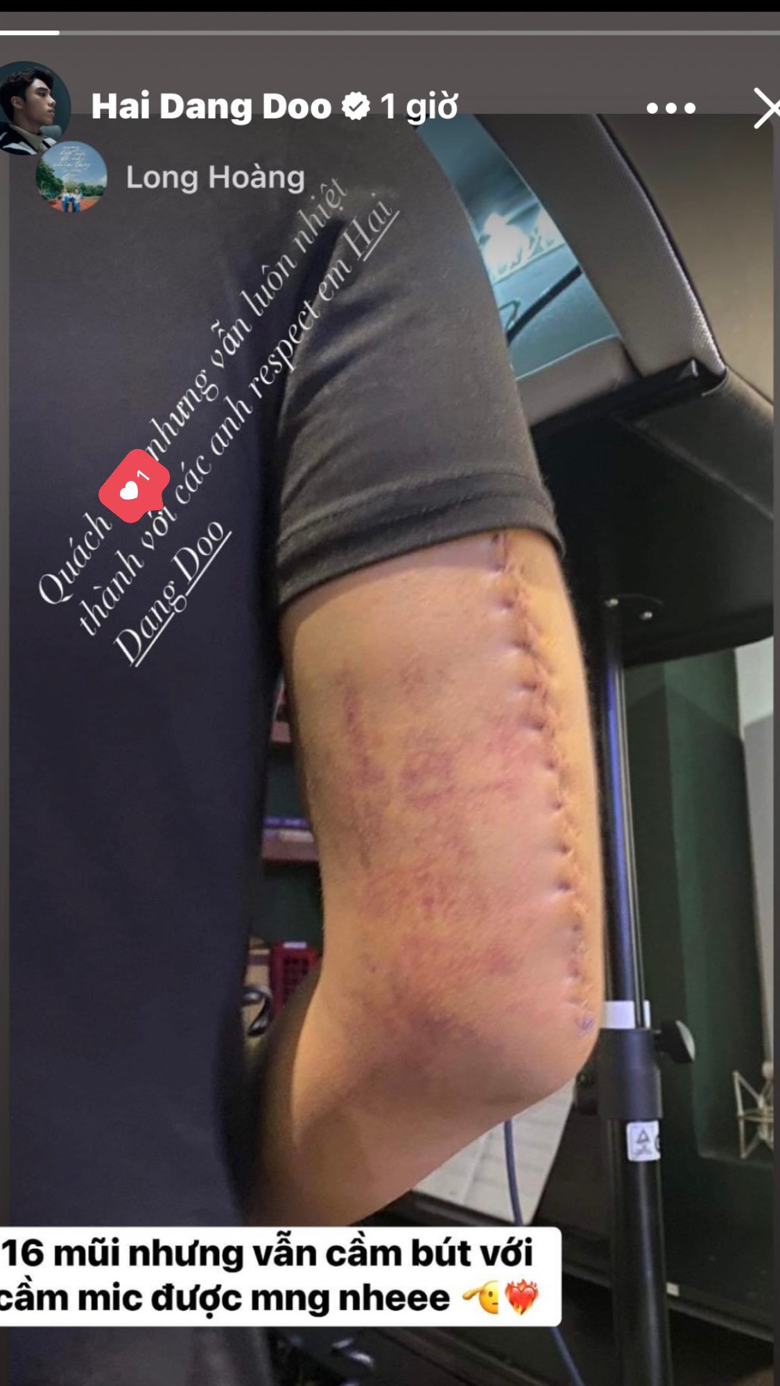 Hải Đăng Doo bị thương nặng ở cánh tay, phải khâu 16 mũi.