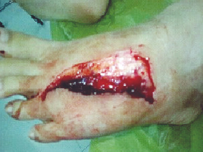 Tấm ốp bô xe bằng Inox cắt trúng phần mu sâu đến tận xương của bé Th. 7 tuổi tại Q.3 TPHCM Ảnh: L.N