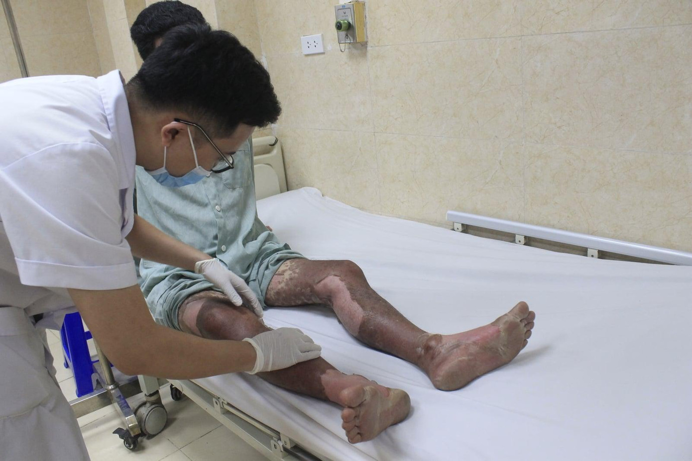 Cả người bệnh nhân chuyển màu nâu, lở loét đau đớn. Ảnh do BS cung cấp Cả người bệnh nhân chuyển màu nâu, lở loét đau đớn. Ảnh do BS cung cấp