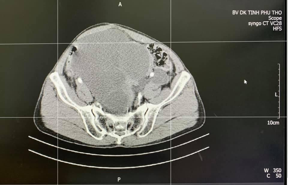 Khối ung thư phát triển trong cơ thể bệnh nhân. Ảnh: BS cung cấp Khối ung thư phát triển trong cơ thể bệnh nhân. Ảnh: BS cung cấp