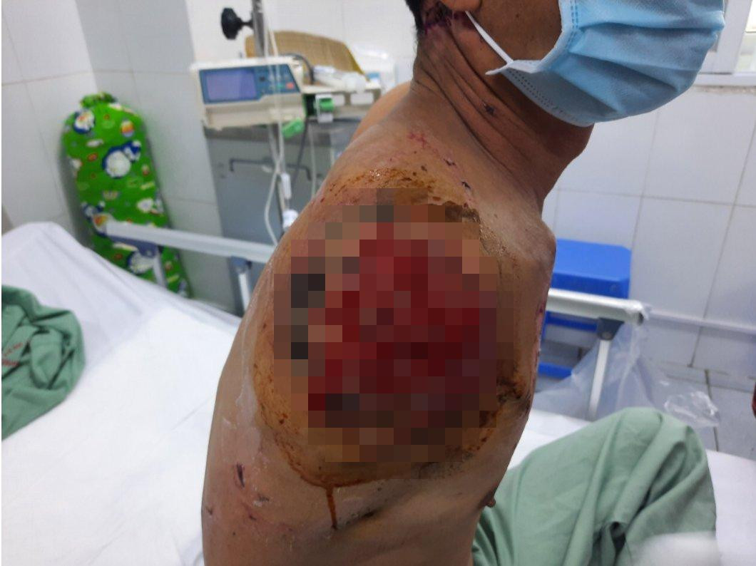 Nạn nhân đang hồi phục sau ca phẫu thuật, tuy nhiên một cánh tay đã không thể giữ được vì dập nát toàn bộ khi bị cuốn vào băng chuyền. Ảnh: BS cung cấp Nạn nhân đang hồi phục sau ca phẫu thuật, tuy nhiên một cánh tay đã không thể giữ được vì dập nát toàn bộ khi bị cuốn vào băng chuyền. Ảnh: BS cung cấp