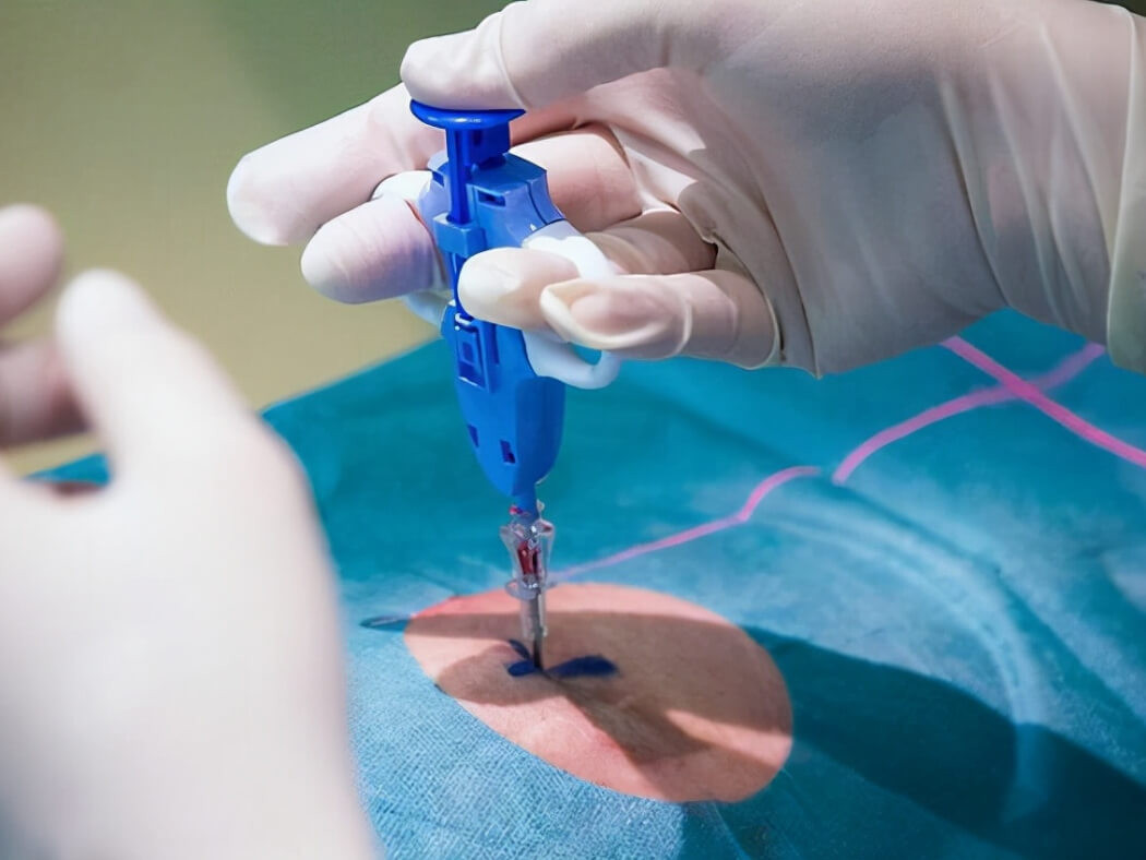 Sinh thiết (lấy mẫu u để xét nghiệm) là cần thiết để chẩn đoán chính xác. Quy trình này được bác sĩ thực hiện rất an toàn và không làm ung thư lây lan hay phát triển nhanh hơn. Ảnh minh họa: Internet