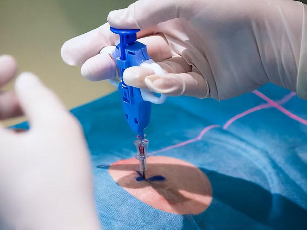 Sinh thiết (lấy mẫu u để xét nghiệm) là cần thiết để chẩn đoán chính xác. Quy trình này được bác sĩ thực hiện rất an toàn và không làm ung thư lây lan hay phát triển nhanh hơn. Ảnh minh họa: Internet Sinh thiết (lấy mẫu u để xét nghiệm) là cần thiết để chẩn đoán chính xác. Quy trình này được bác sĩ thực hiện rất an toàn và không làm ung thư lây lan hay phát triển nhanh hơn. Ảnh minh họa: Internet