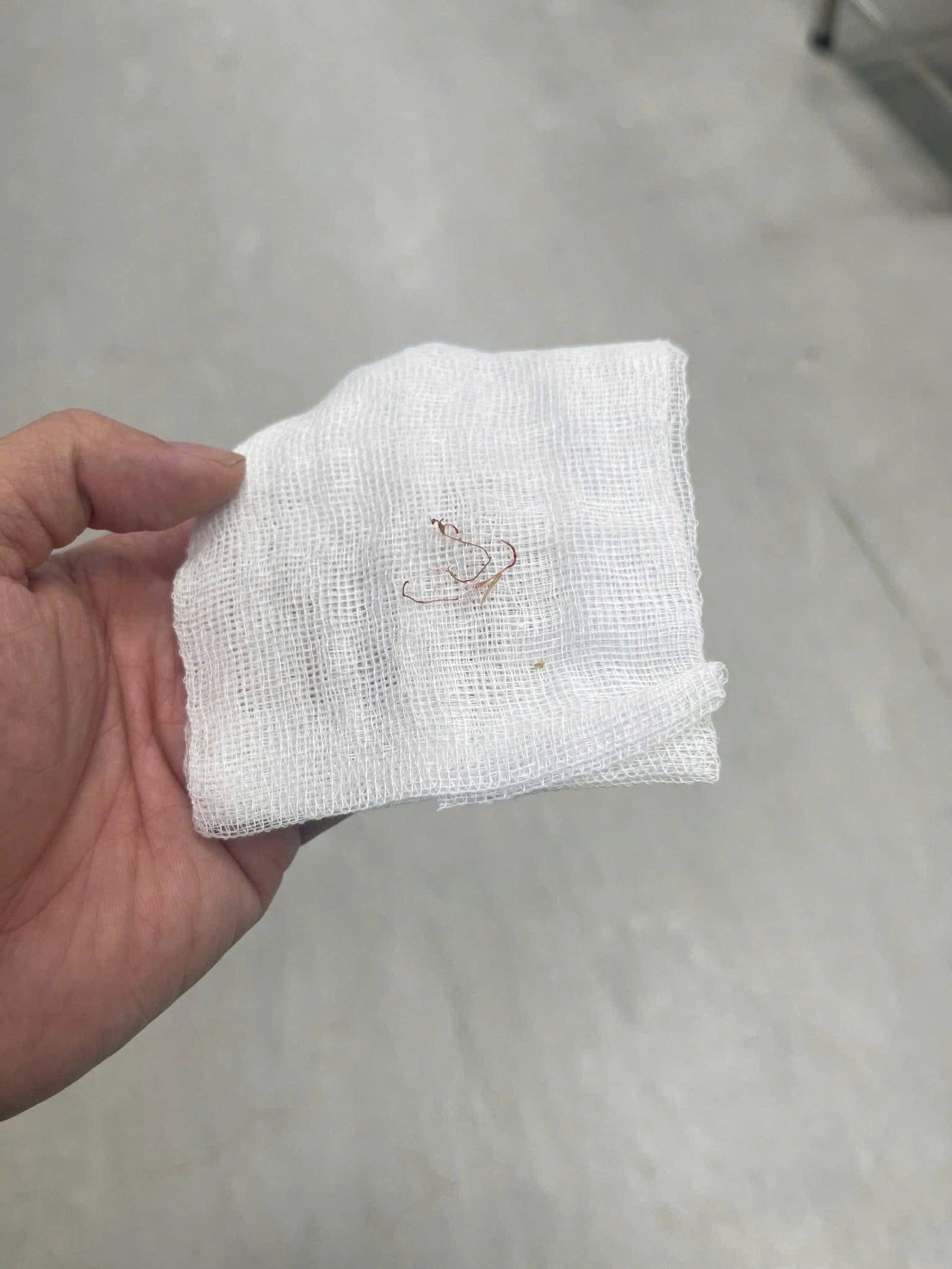 Sợi chỉ được gắp từ má bệnh nhân Sợi chỉ được gắp từ má bệnh nhân