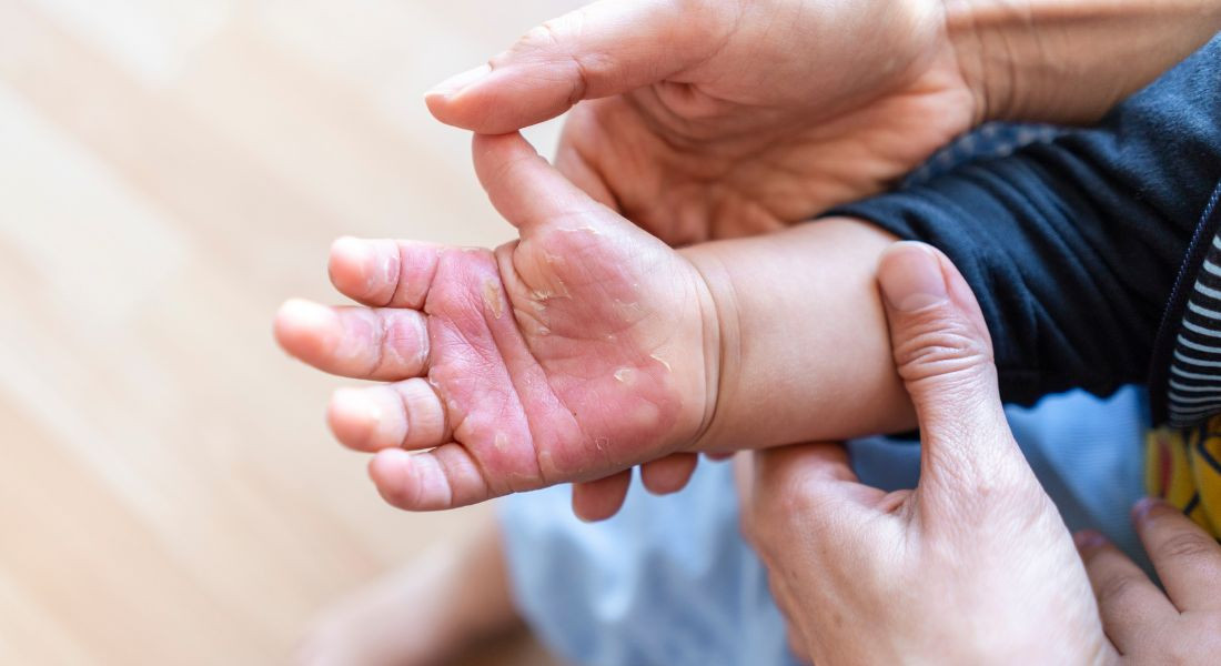 Cẩn trọng với tai nạn bỏng ở trẻ nhỏ. Cẩn trọng với tai nạn bỏng ở trẻ nhỏ.