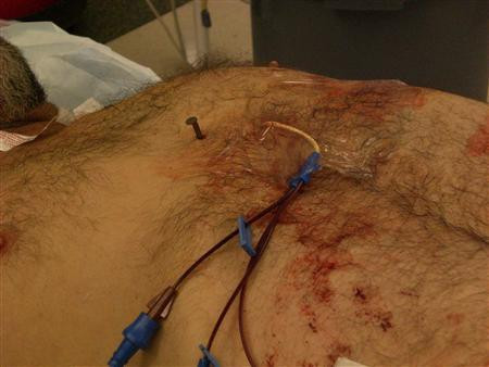 Chiếc đinh dài 10 cm đâm trúng tâm thất phải của anh Dennis Hennis