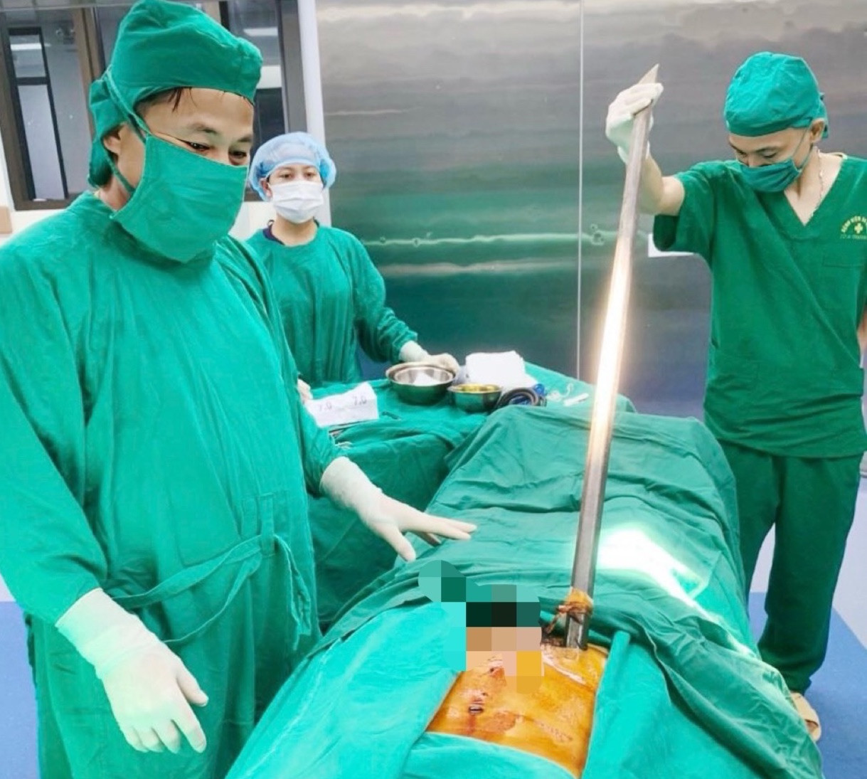 Thanh xà beng đâm xuyên thành bụng