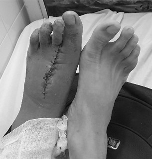 Phẫu thuật ‘dời’ ngón chân lên làm ngón tay cái cho nam bệnh nhân ảnh 2